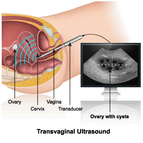 Transvaginal Ultrasounds